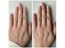 ベルティフィー(belltiffy)の雰囲気（自爪育成&ハンドエステ症例【手のシワを改善したい】）