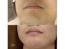 アピール(Appeal)/お客様BeforeAfter-ヒゲ脱毛-