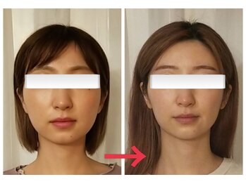 ミラクル(Miracle)/アフターの写真