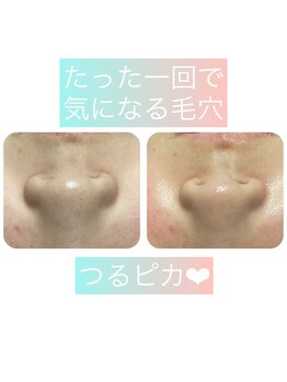 ルアナ(LUANA)/ハイドロピーリング水素毛穴洗浄