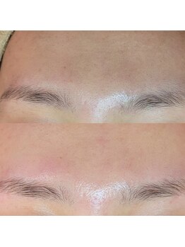 顔肌革命 ビューティアンドヘルス バイ メール(beauty&health by mer)/フェイシャルワックス脱毛