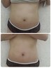 ★【ぽっこりお腹・二の腕・太もも・背中】集中シェイプ