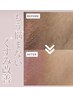 【黒ずみ除去】デリケートゾーンの黒ずみケア