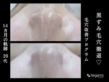 レガロビューティクリエイションズ桜川店/脱・黒ずみ！毛穴改善プログラム