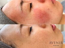 アベニール 芦屋/肌質改善ビフォーアフター