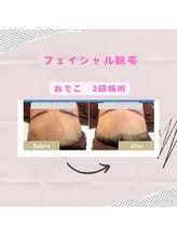 アンリール 旭川店(Anrire)/お顔の脱毛人気です！