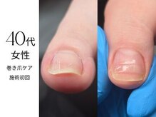 フットケア クラッシー(footcare classy)/見た目は綺麗だけど痛む巻き爪