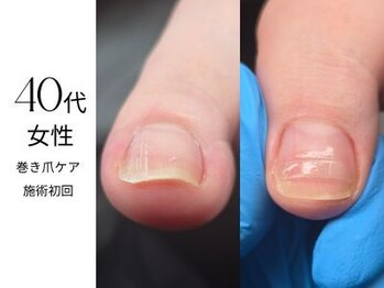 フットケア クラッシー(footcare classy)/見た目は綺麗だけど痛む巻き爪