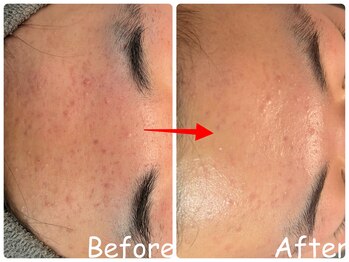 エレ(ele)/【施術1回】赤みニキビ改善ハ-ブ