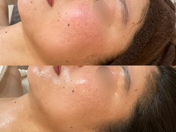 ビジュープラス 広島店(Bijou+)/【30代/赤み、毛穴開き】