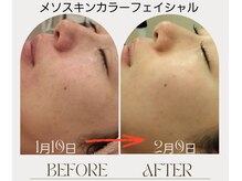 マールム(MALUM)/メソスキンカラー