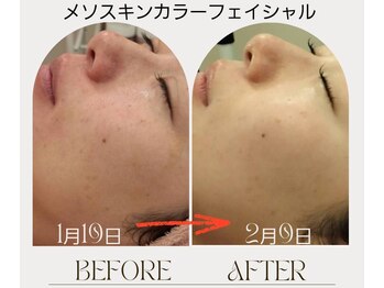 マールム(MALUM)/メソスキンカラー