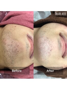 ロス(Loss)/ヒゲ脱毛3回目