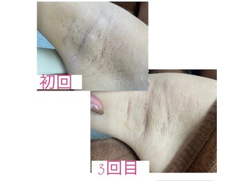 ネズ(Nezu)/【レディース脱毛】脇脱毛