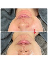 ダリア(Dahlia)/ハーブピーリング