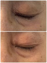 プリュネル(Prunelle)/プラズマシャワー