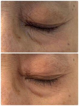 プリュネル(Prunelle)/プラズマシャワー