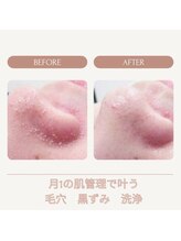 ラグラン銀座メディカルエステ 高輪ゲートウェイ店/最先端毛穴ハイドラフェイシャル