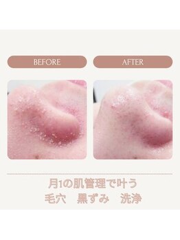 ラグラン銀座メディカルエステ 高輪ゲートウェイ店/最先端毛穴ハイドラフェイシャル