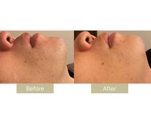 リフサロ(Rifsaro)/ヒゲ脱毛11回 Before/After