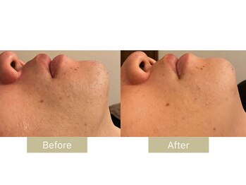 リフサロ(Rifsaro)/ヒゲ脱毛11回 Before/After