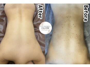 グロウ(GLOW)/ハーブピーリングで美背中★