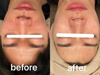 ヴィセラ(Vicella)/一回施術後毛穴ツルツル