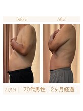 アクア(AQUA)/ハイパーナイフ痩身☆
