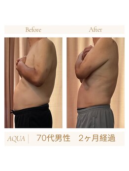 アクア(AQUA)/ハイパーナイフ痩身☆