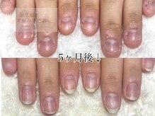 深爪矯正 爪悩み専門店 cocomo/(深爪/長さだし/フィルイン)
