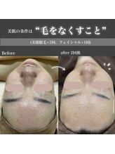 エステティック レイビス 八戸店(RAYVIS)/美肌の条件は毛をなくすこと！