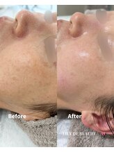 リリードボーテ 高槻店(LILY DE BEAUTE)/色素・シミケアBefore/After