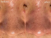 アワピール 天王寺店(AWA PEELL)/毛穴洗浄/天王寺/毛穴洗浄/小顔