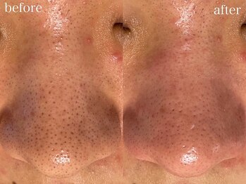 アワピール 天王寺店(AWA PEELL)/毛穴洗浄/天王寺/毛穴洗浄/小顔