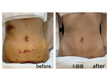 ムイエ(mouiller)/インディバ術後ケア 施術