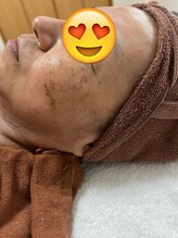 プラーベートサロン エクラ(eclat)/ハーブピーリング