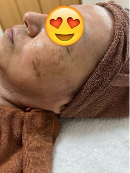 プラーベートサロン エクラ(eclat)/ハーブピーリング