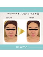 ニュウミー 諏訪本店(newme)/小顔　ビフォーアフター9