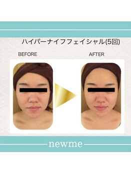 ニュウミー 諏訪本店(newme)/小顔　ビフォーアフター9