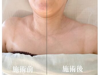 サピュイエ(S'appuyer)/肩の盛り上がり改善