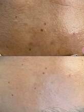 ユウビ ビューティー サロン(Yuubi)/【peel stage】ハーブピーリング