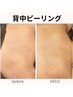 【背中ピーリング】￥9000背中ニキビケア、黒ずみに◎
