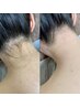 Jrワクサー【女性うなじ＆顔ワックス】背中上部シェービング付き　￥5,800