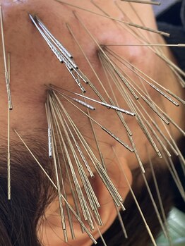ふじた鍼灸整体院/鬼美容鍼(局所集中施術)