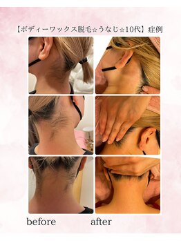 ソワイユ 浜松店(Soyeux)/ワックス脱毛 before→after