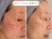 フラックス 京都(FLUX)/【エンビロン】たるみ毛穴コース