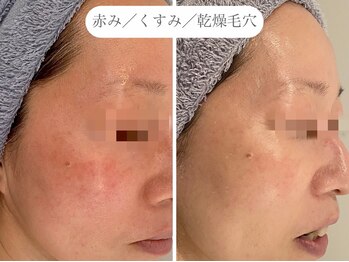 フラックス 京都(FLUX)/【エンビロン】たるみ毛穴コース