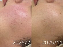 アンリミット 原宿竹下通り店(Une limit)/9ヶ月肌質改善経過 before after