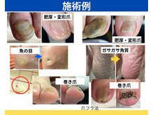 元看護師のフットケアサロン ナチュエイド【巻き爪・厚い爪・魚の目・タコ・角質】