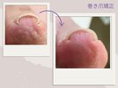 【痛みを我慢しない】巻き爪矯正